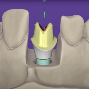 Custom Abutments